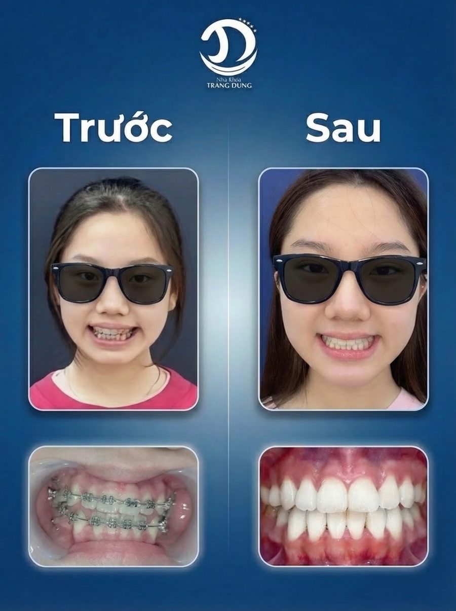 Ca niềng thực tế - trước và sau